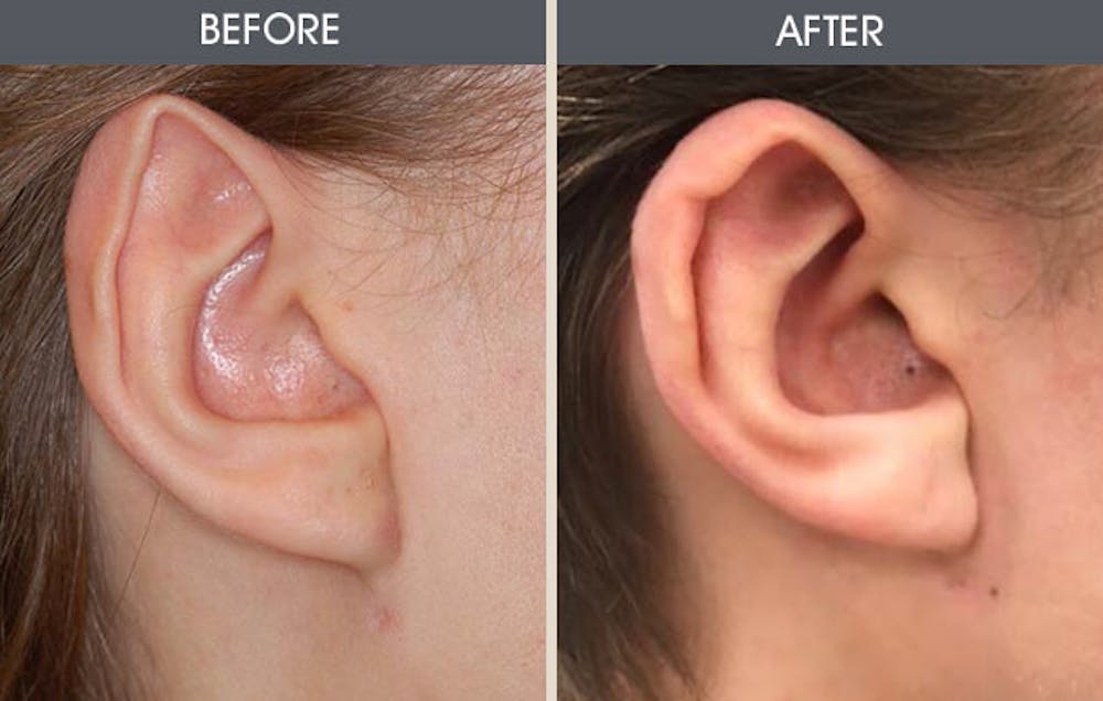 Ear Surgery Before & After Gallery - Patient 2206585 - Image 1