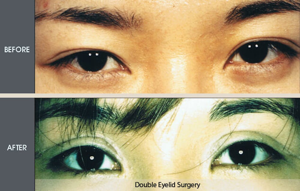 Eyelid Surgery (Blepharoplasty) Gallery Before & After Gallery - Patient 2206586 - Image 1