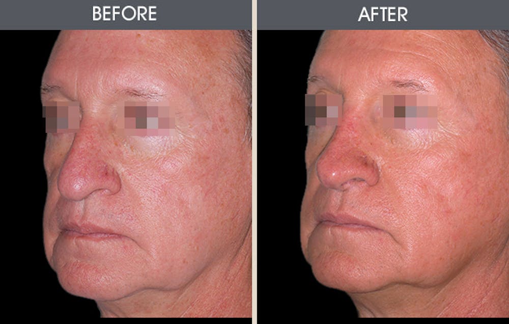 Rhinoplasty Before & After Gallery - Patient 2206589 - Image 1