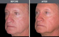 Rhinoplasty Gallery Before & After Gallery - Patient 2206589 - Image 1