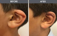 Ear Surgery Before & After Gallery - Patient 2206611 - Image 1