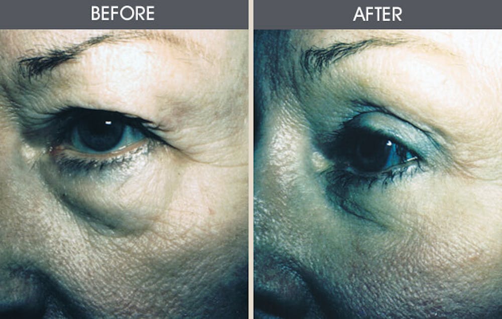 Eyelid Surgery (Blepharoplasty) Gallery Before & After Gallery - Patient 2206615 - Image 1