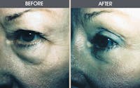 Eyelid Surgery (Blepharoplasty) Gallery Before & After Gallery - Patient 2206615 - Image 1