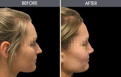 Rhinoplasty Gallery Before & After Gallery - Patient 2206627 - Image 1