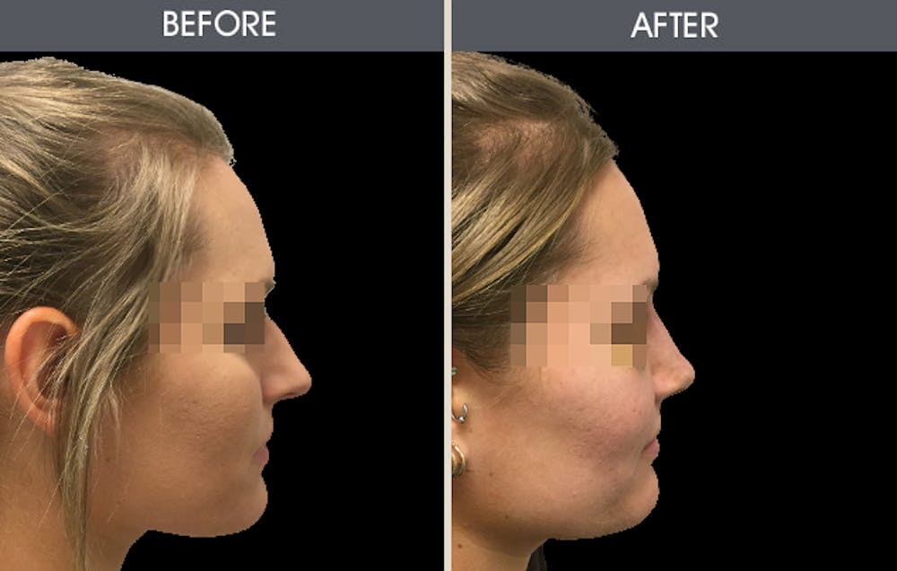 Rhinoplasty Before & After Gallery - Patient 2206627 - Image 1