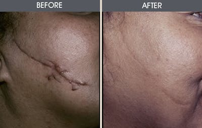 Scar Revision Gallery Before & After Gallery - Patient 2206629 - Image 1