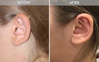 Ear Surgery Gallery Before & After Gallery - Patient 2206630 - Image 1
