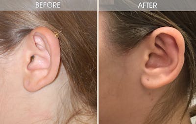 Ear Surgery Before & After Gallery - Patient 2206630 - Image 1