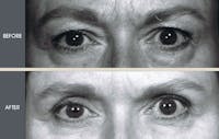 Eyelid Surgery (Blepharoplasty) Gallery Before & After Gallery - Patient 2206628 - Image 1