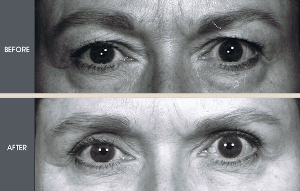 Eyelid Surgery (Blepharoplasty)  Before & After Gallery - Patient 2206628 - Image 1