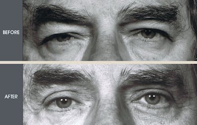 Eyelid Surgery (Blepharoplasty) Gallery Before & After Gallery - Patient 2206645 - Image 1