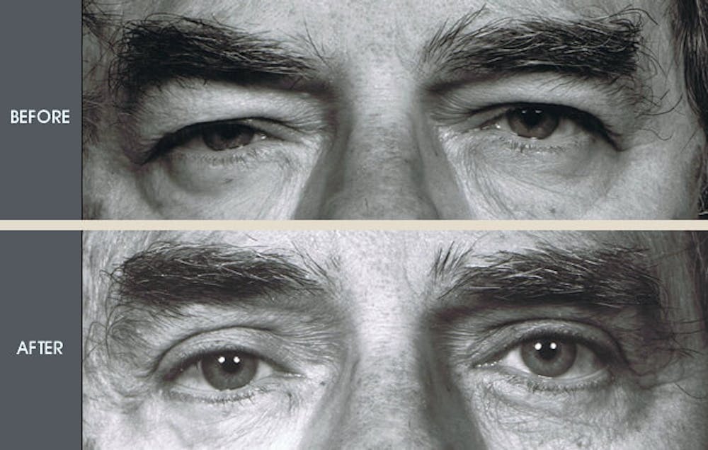 Eyelid Surgery (Blepharoplasty)  Before & After Gallery - Patient 2206645 - Image 1