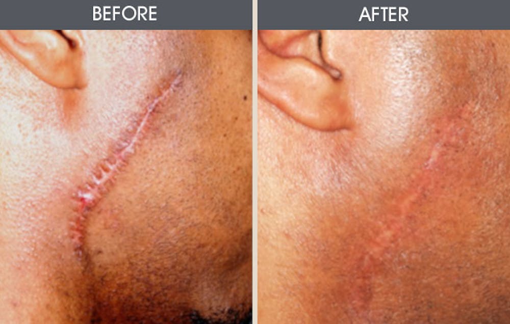 Scar Revision Before & After Gallery - Patient 2206648 - Image 1