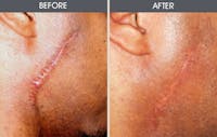 Scar Revision Before & After Gallery - Patient 2206648 - Image 1