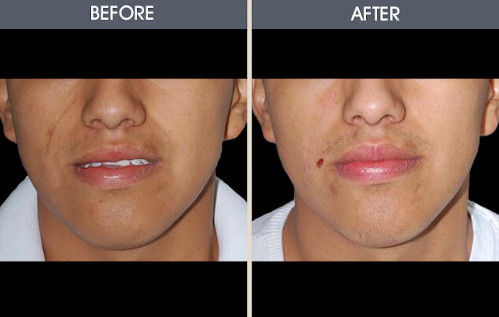Scar Revision Before & After Gallery - Patient 2206702 - Image 1