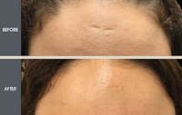 Scar Revision Before & After Gallery - Patient 2206716 - Image 1