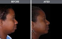 Chin Implants Before & After Gallery - Patient 2206735 - Image 1