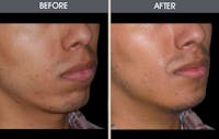 Chin Implants Before & After Gallery - Patient 2206752 - Image 1