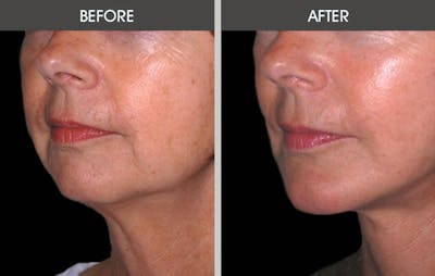 Chin Implants Before & After Gallery - Patient 2206771 - Image 1