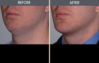 Chin Implants Gallery Before & After Gallery - Patient 2206773 - Image 1