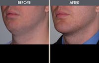 Chin Implants Before & After Gallery - Patient 2206773 - Image 1