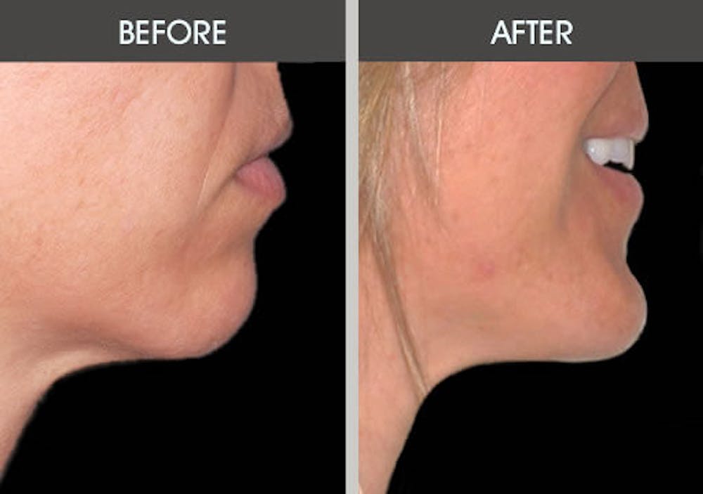 Chin Implants Gallery Before & After Gallery - Patient 2206791 - Image 1