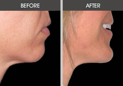 Chin Implants Before & After Gallery - Patient 2206791 - Image 1