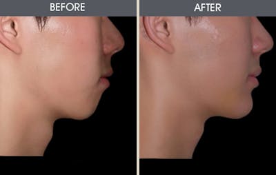 Chin Implants Gallery Before & After Gallery - Patient 2206796 - Image 1