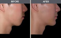 Chin Implants Before & After Gallery - Patient 2206796 - Image 1
