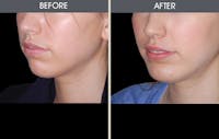 Chin Implants Before & After Gallery - Patient 2206820 - Image 1