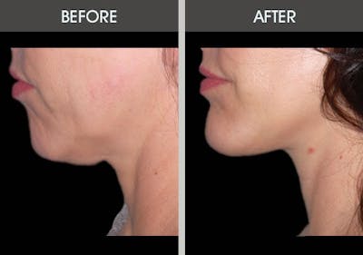 Chin Implants Gallery Before & After Gallery - Patient 2206834 - Image 1