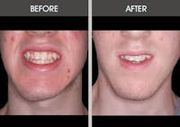 Chin Implants Gallery Before & After Gallery - Patient 2206846 - Image 1