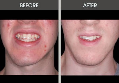 Chin Implants Before & After Gallery - Patient 2206846 - Image 1