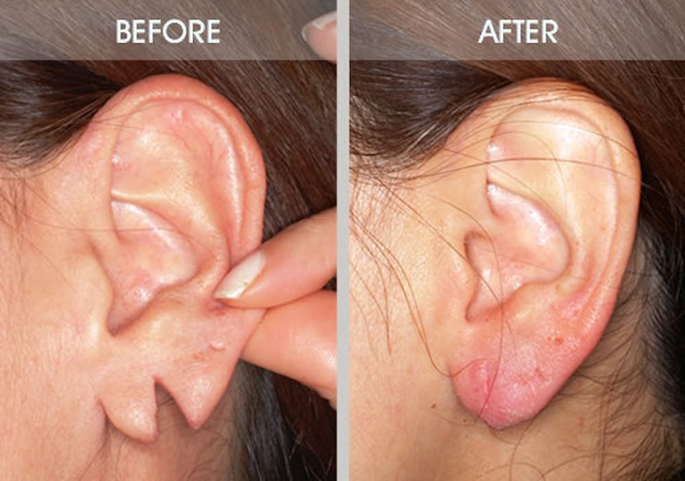 Earlobe Repair Before & After Gallery - Patient 2207110 - Image 1