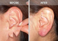 Earlobe Repair Before & After Gallery - Patient 2207110 - Image 1