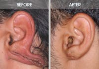 Earlobe Repair Before & After Gallery - Patient 2207115 - Image 1