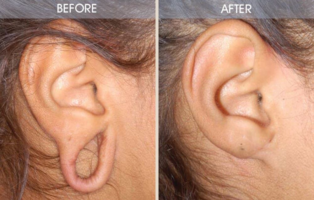 Earlobe Repair Gallery Before & After Gallery - Patient 2207116 - Image 1