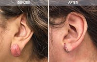 Earlobe Repair Gallery Before & After Gallery - Patient 2207117 - Image 1