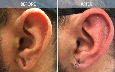 Earlobe Repair Gallery Before & After Gallery - Patient 2207119 - Image 1