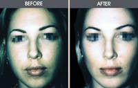 Buccal Fat Removal Gallery Before & After Gallery - Patient 2207141 - Image 1