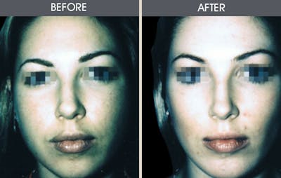 Buccal Fat Removal Gallery Before & After Gallery - Patient 2207141 - Image 1