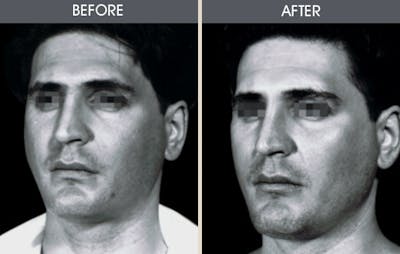 Buccal Fat Removal Before & After Gallery - Patient 2207142 - Image 1