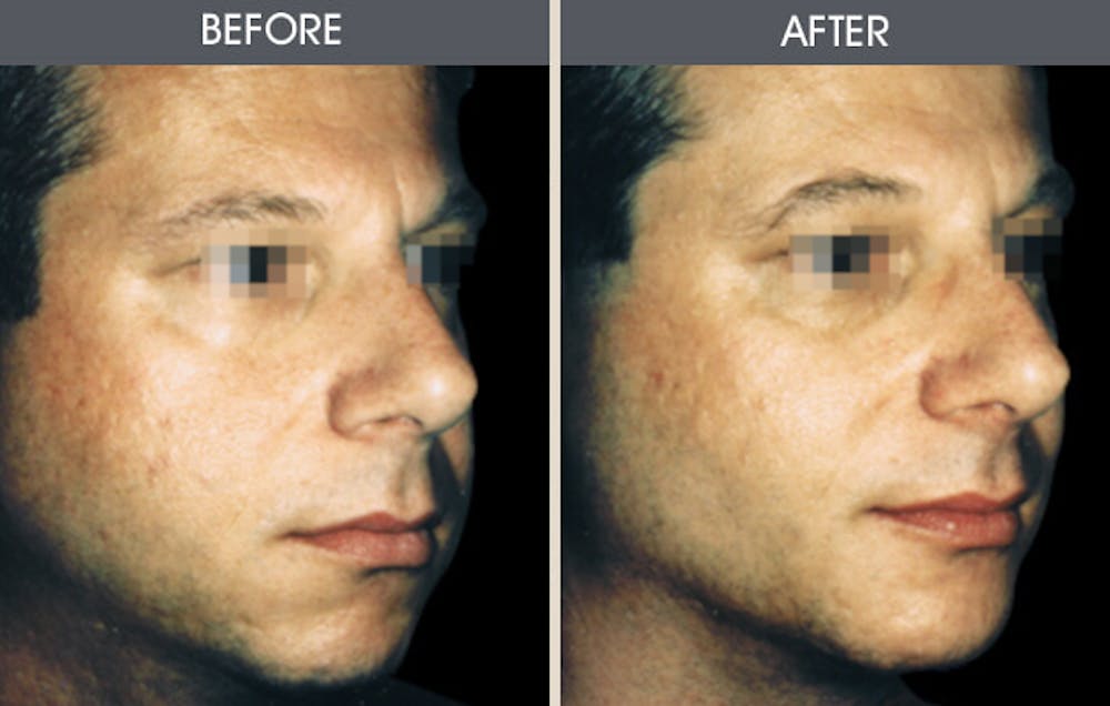 Buccal Fat Removal Before & After Gallery - Patient 2207143 - Image 1