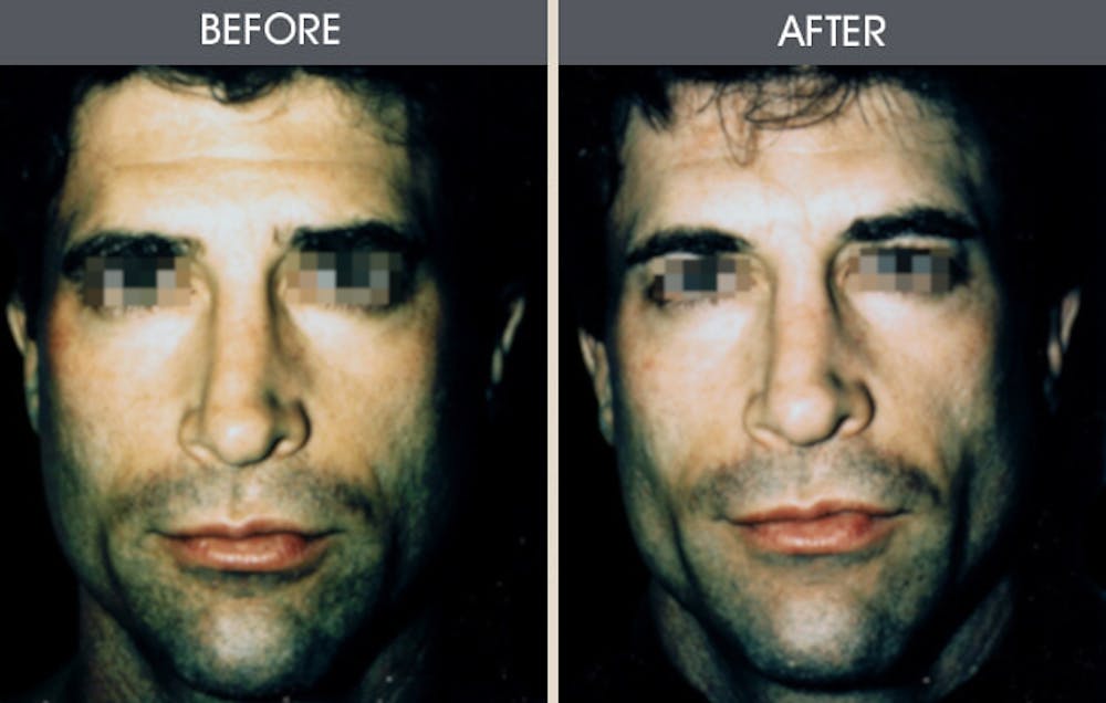 Buccal Fat Removal Gallery Before & After Gallery - Patient 2207145 - Image 1