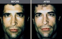 Buccal Fat Removal Gallery Before & After Gallery - Patient 2207145 - Image 1