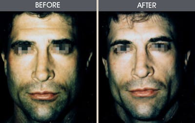 Buccal Fat Removal Before & After Gallery - Patient 2207145 - Image 1