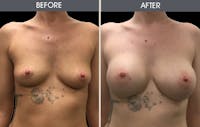 Breast Augmentation Before & After Gallery - Patient 2207151 - Image 1