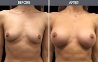 Breast Augmentation Before & After Gallery - Patient 2207153 - Image 1