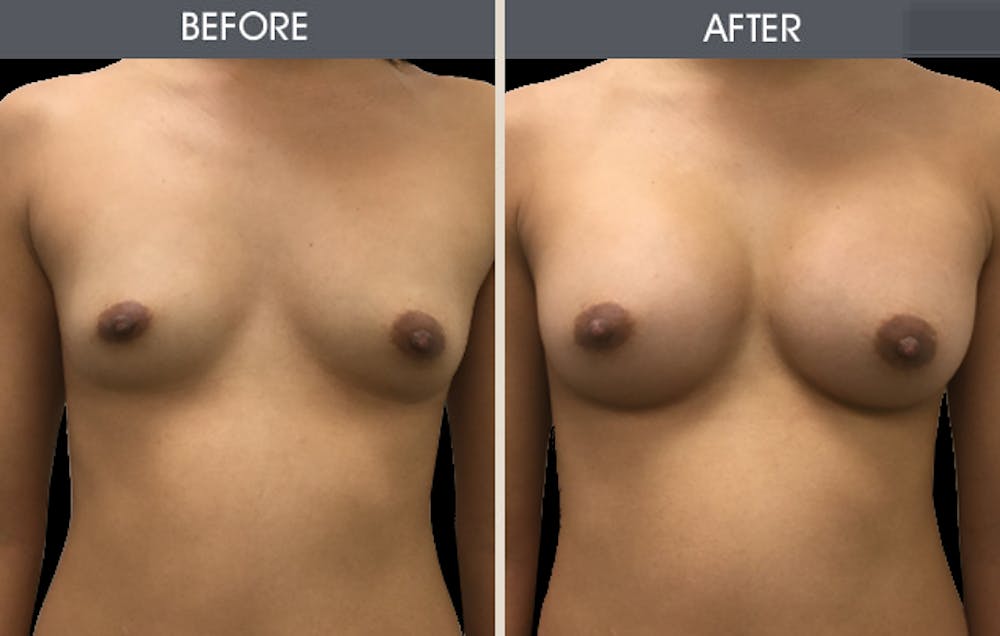 Breast Augmentation Gallery Before & After Gallery - Patient 2207154 - Image 1
