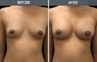Breast Augmentation Gallery Before & After Gallery - Patient 2207154 - Image 1